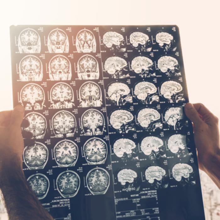 Covid-19. Efecte neurologice grave, la o treime din pacienți