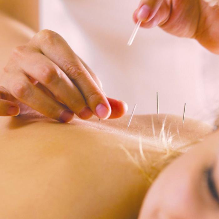 (P) Acupunctura: ce trebuie să știi despre această procedura antică de tratament