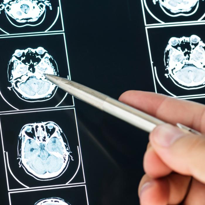 Musk anunță că primul implant cerebral la om de la Neuralink este un succes