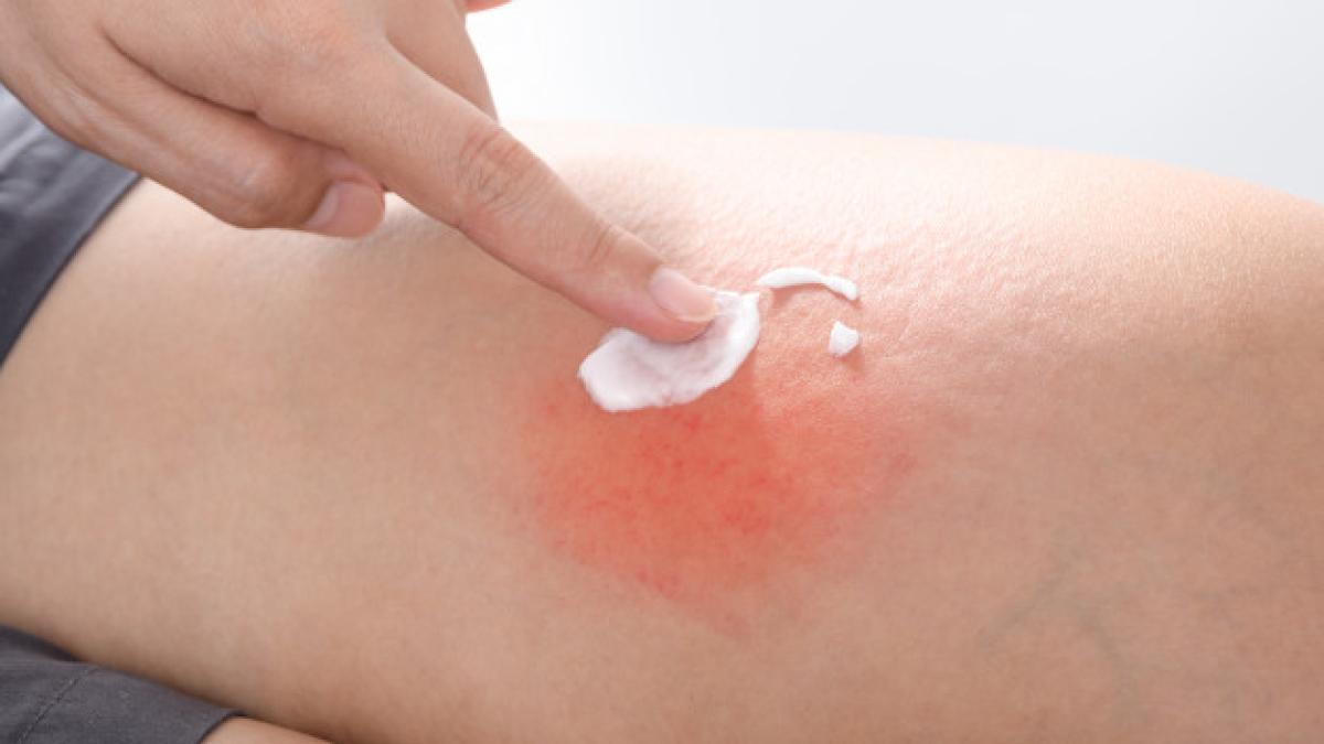 scratch_allergic_skin_from_mosquito_insect_bites_apply_medicine_cream_1962_991_12422400