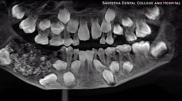 Unui copil i-au fost extrași 526 de dinți. Cum a fost posibil