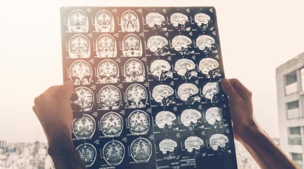 Covid-19. Efecte neurologice grave, la o treime din pacienți