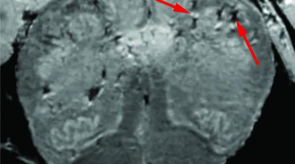Covid-19. Medicii au descoperit cum este afectat creierul