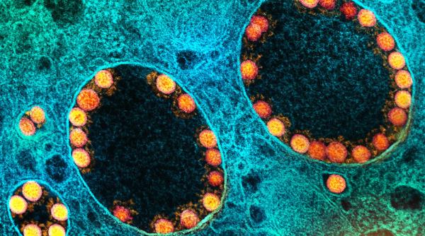 COVID-19. Diferențe de anticorpi între vaccinați și convalescenți