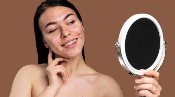 Îngrijirea tenului gras cu tendință acneică: 5 sfaturi utile 